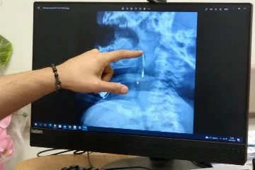 Böylesi ne görüldü ne duyuldu! 8 aylık bebeğin röntgeni çılgına çevirdi!